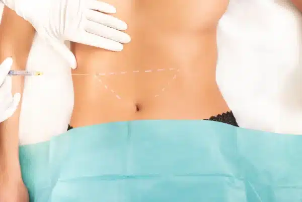 Microcanula SoftFil PRecision